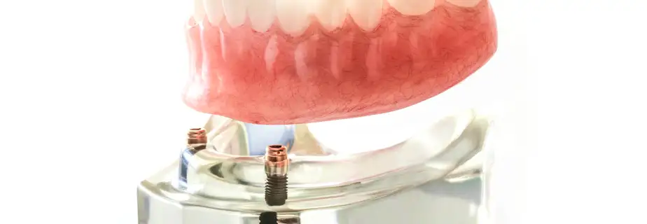 インプラントオーバーデンチャー