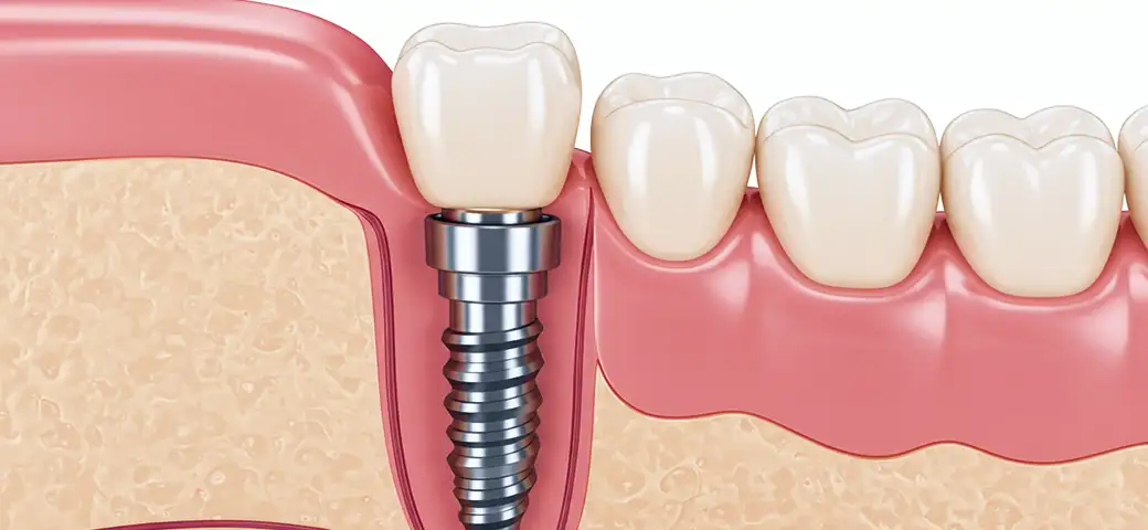 ノーベルバイオケア社・ストローマン社製インプラント